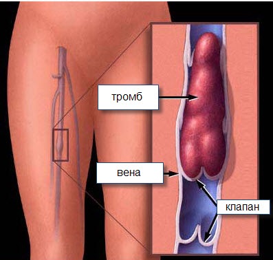 Amint különböztetni a thrombophlebitis trombózis, visszértágulat, visszérgyulladás mind kezeletlen patológiák