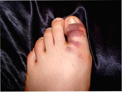 törött lábujj ellátása súlyos fájdalom a nagy lábujjak ízületeiben