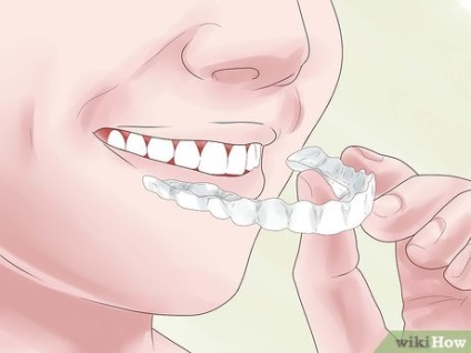 Hogyan, hogy összehangolják a fogak nélkül zárójelek segítségével Invisalign