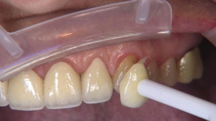 Hogyan, hogy összehangolják a fogak korrekció és a korrekció görbületének fogak