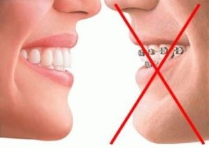 Fogvédő fogak igazítás és harapás korrekciója