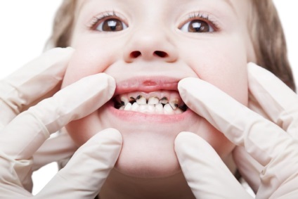 A fogszuvasodás gyermekeknél okoz, kezelések és a megelőzés
