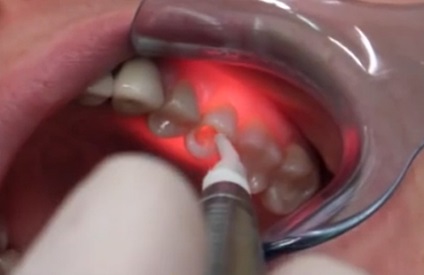 Laser orvos mosolya - kezelésére fogak és az íny lézeres fogászati ​​szakember ó -1 Lana,