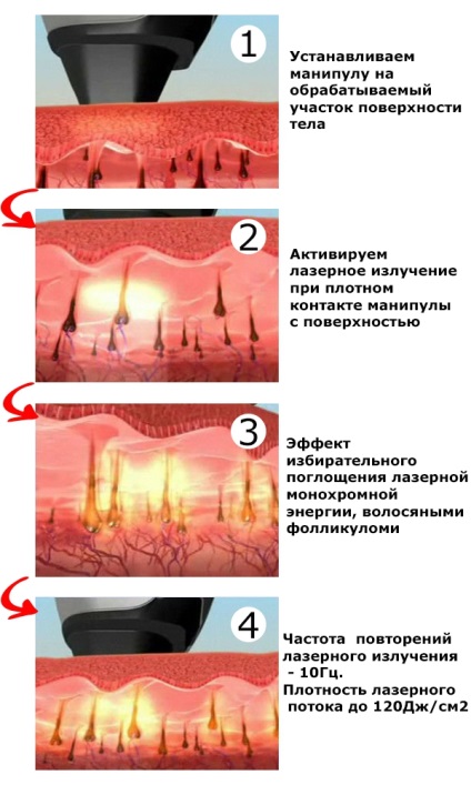 Lézeres szőrtelenítő - az eljárás leírása