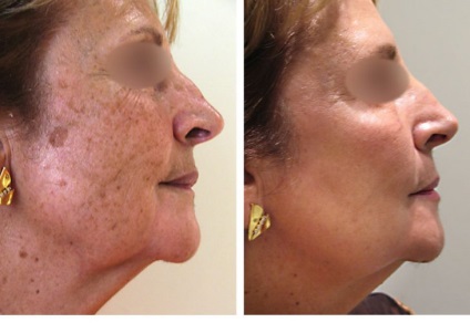 Lézeres eltávolítása pigmentált foltok az arcon - Árak, visszajelzések
