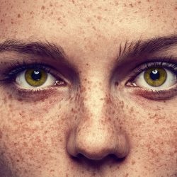 Lézeres eltávolítása pigmentált foltok az arcon - Árak, visszajelzések