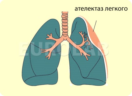 A kezelés a tüdő atelectasia - orvosi portál EUROLAB