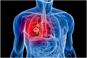 A kezelés az akut bronchitis felnőtteknél (az akut bronchitis) Kezelése akut bronchitis felnőtteknél