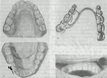 A kezelés a kóros kopása fogak