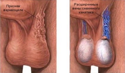 varicocele kezelés műtét nélkül - e, és ha igen, milyen mértékben lehet hatékonyan