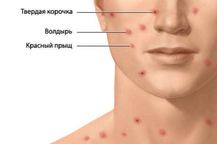Gyógyszer allergia tünetek és a kezelés