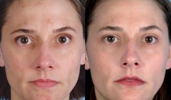 A mechanikai tisztítás az arc véleménye, fotók előtt és után