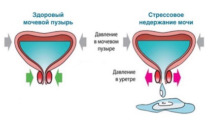 A vizelet nem marad, és mit kell tenni a stressz és a leküzdhetetlen inkontinencia