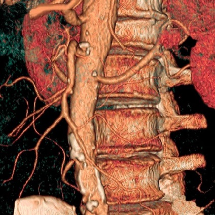 MRI vagy CT osteochondrosis, mit válasszon a diagnosztikai képalkotó