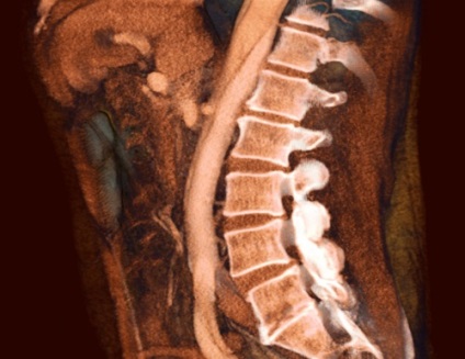 MRI vagy CT osteochondrosis, mit válasszon a diagnosztikai képalkotó