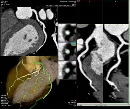 MSCT angiográfia - a kezelés a szív