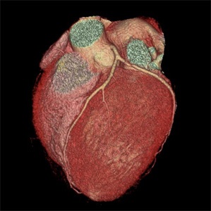 MSCT angiográfia - a kezelés a szív