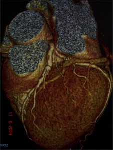 MSCT angiográfia - a kezelés a szív