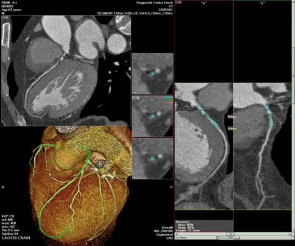 MSCT angiográfia - a kezelés a szív