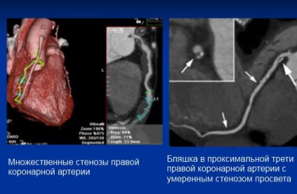 MSCT a szív (koszorúér angiográfia) kontraszt