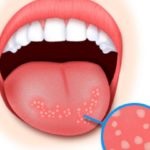 Népi jogorvoslati fogfájás - a leghatékonyabb receptek