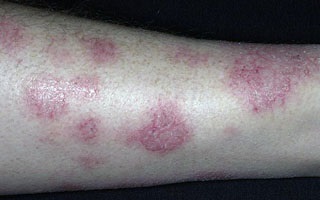 Ideges dermatitis, okok, tünetek és kezelési lehetőségek, fotó