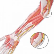 Neuropátia a nervus ulnaris ízületi betegségek - Causes, tünetek és kezelés