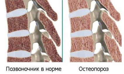 Csontritkulás gyermekeknél (yuvenialny) okai, tünetei, kezelése