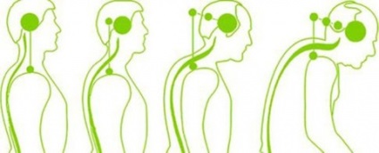 Osteochondrosis a nyaki gerinc tünetek és a kezelés a nyaki degeneratív betegség lemez