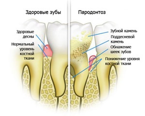 A periodontális betegség, mint egy fénykép menteni a fogak, a tünetek, kezelés, gyógyszeres kezelés, az Ön (mentő) A periodontális betegség, mint egy fénykép menteni a fogak, a tünetek, kezelés, gyógyszeres kezelés, az Ön