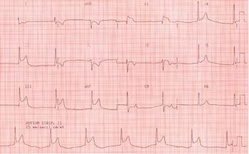 Elsősegély és rehabilitációs „szív szünet” (miokardiális infarktus) tünetei és kezelése