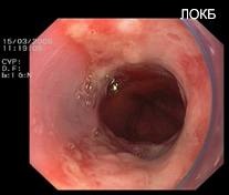 Indikációk sebészeti kezelésére gastrooesophagealis reflux betegség