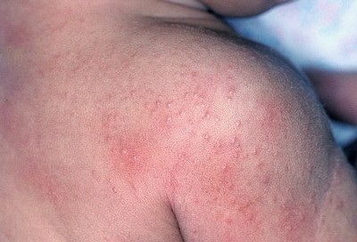 Tünetei allergia a nap egy gyermek