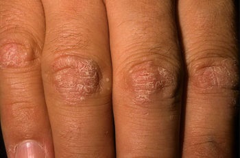 Psoriasis a kezében a tünetei, kezelése, krémek és kenőcsök a psoriasis a kéz és a tenyér