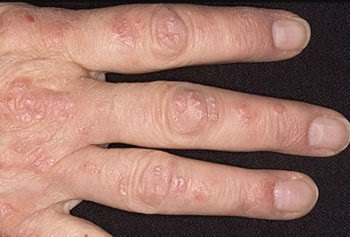 Psoriasis a kezében a tünetei, kezelése, krémek és kenőcsök a psoriasis a kéz és a tenyér