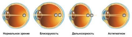 A különbség a asztigmatizmus és a myopia a betegségek a szem (a különbség) A különbség a asztigmatizmus és myopia körülbelül szembetegség
