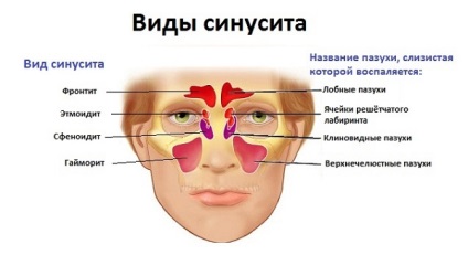 Az orrmelléküreg-gyulladás és arcüreggyulladás - mi a különbség