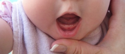 Stomatitis csecsemők - hogyan lehet azonosítani, megfelelően kezelik, profilaktirovat
