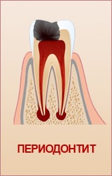 Traumás periodontitis (periodontális akut traumás kezelés) traumatikus periodontitis