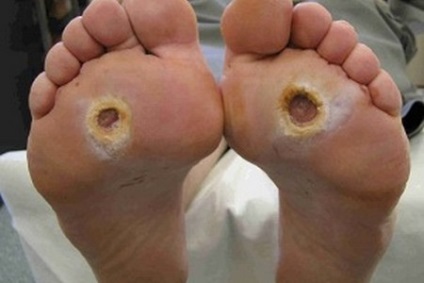 Diabéteszes láb - home sebek kezelésére a lábát a cukorbetegség