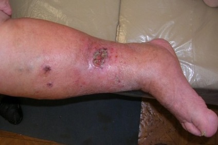 Fekély a lábak okok és a kezelés függően patológia fajokra