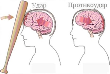agyi zúzódás tünetek, következmények kezelésére