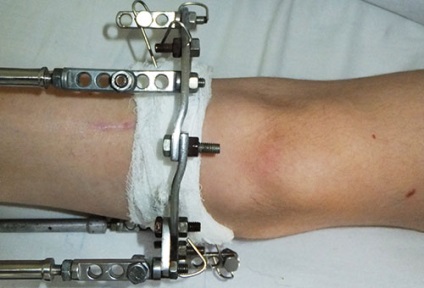 Varus deformitás a láb okok és a kezelés