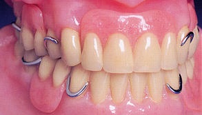 Fogászati implantátumok (implantátumok) - Előnyök és hátrányok (implantátumok) Fogászati implantátumok (implantátumok) - Előnyök és hátrányok