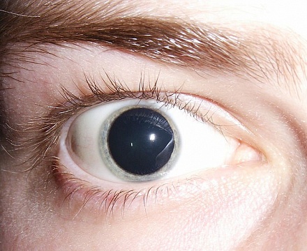 Aniridia szemek - okai és kezelése