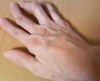 Arthritis a Csuklóízület készítmények a fájdalom kezelésére társuló ízületi gyulladás gerenda (csukló) Arthritis a Csuklóízület készítmények a fájdalom kezelésére társuló ízületi gyulladás ray