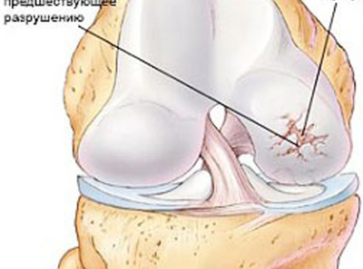 Arthritis a Csuklóízület készítmények a fájdalom kezelésére társuló ízületi gyulladás gerenda (gyógyszerek) Arthritis a Csuklóízület készítmények a fájdalom kezelésére társuló ízületi gyulladás ray