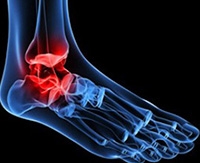 Arthritis a Csuklóízület készítmények a fájdalom kezelésére társuló ízületi gyulladás gerenda (közös) Arthritis a Csuklóízület készítmények a fájdalom kezelésére társuló ízületi gyulladás ray