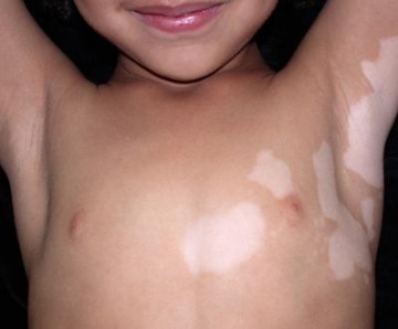 Fehér foltok a bőrön gyermekeknél okoz, kezelések és a megelőzés