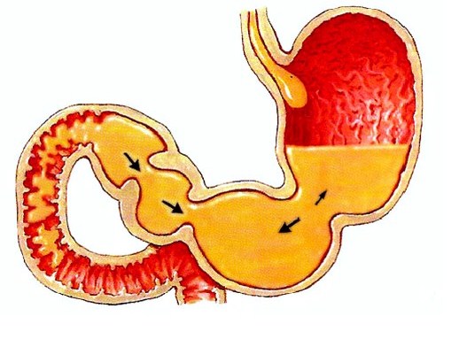 Biliaris reflux gastritis és reflux esophagitis, tünetek